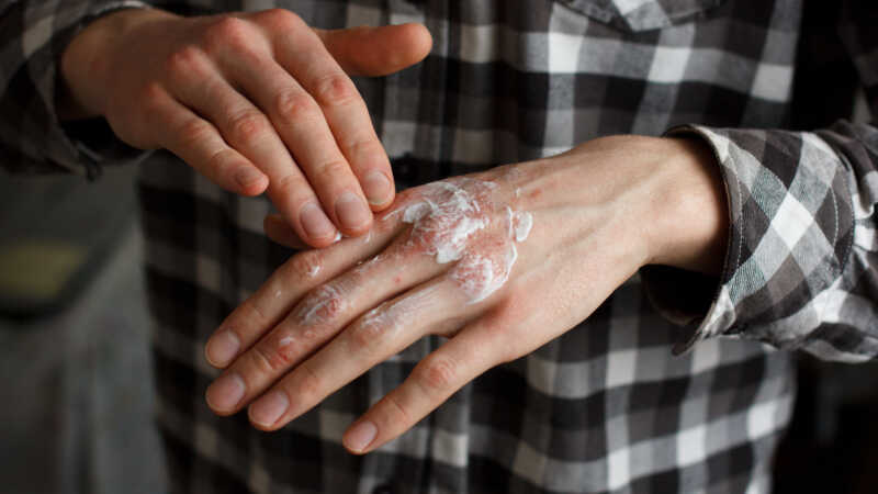 Simple Psoriasis Treatments That Can Relieve Annoying Itchiness