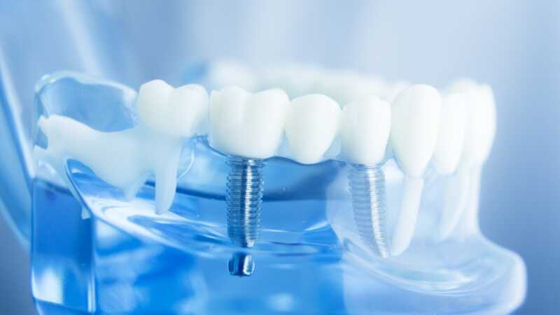 How to Get Low Cost Dental Implants